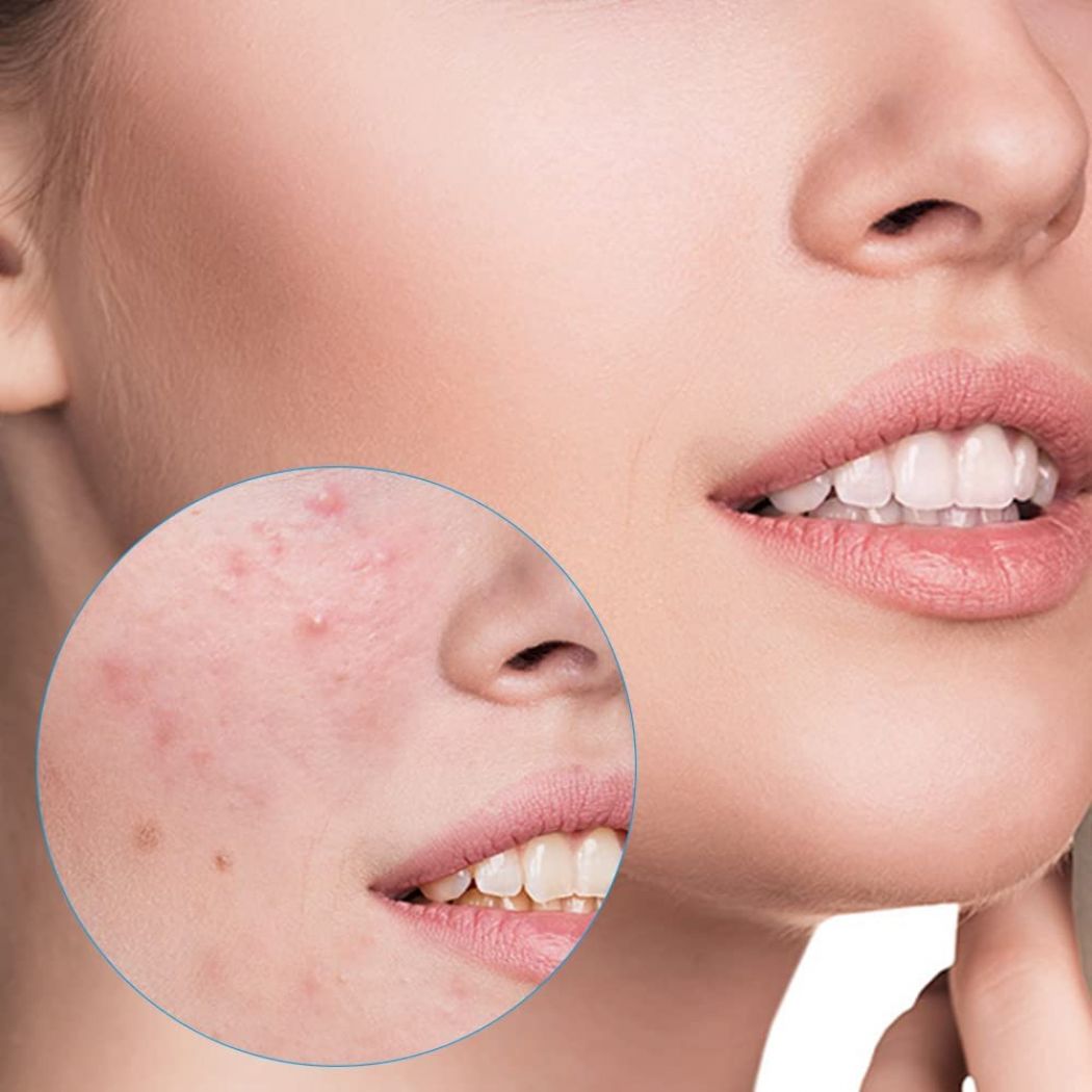 3 in 1 Anti Aging Anti Wrinkles Removal Device